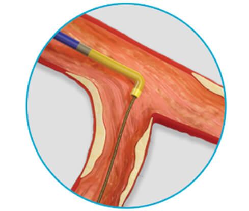 supercross microcatheters